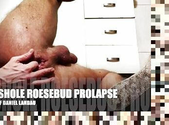 ASSHOLE ROSEBUD PROLAPSE